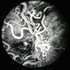Retinal AV malformation FA 1